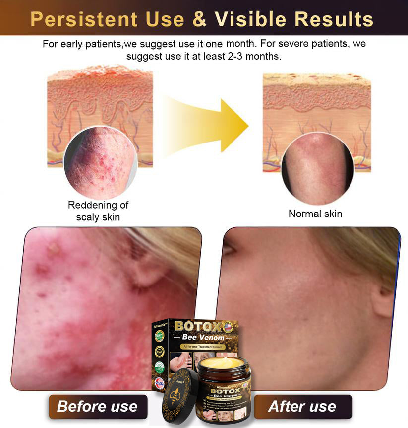 "Made and Shipped from USA | Alisanda™ BOTOX Bee Venom All-in-one Treatment Cream | LAST DAY 70% OFF "