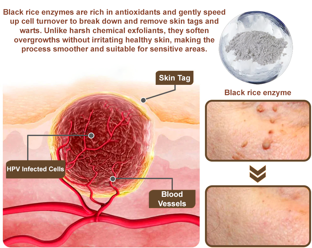 ZvoRia™ Black Rice Skin Repair Essence Cream ⚕️ FDA Certified (Eliminates warts and skin tags, relieves psoriasis, improves keratin build-up and follicular keratinization, fades pigmentation, sun spots & age spots)