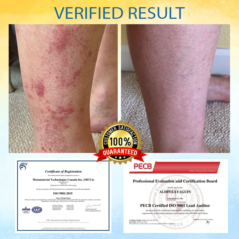 LOVILDS™ Psoriasis Care Mellifera Venom Skin Healing Spray🔥