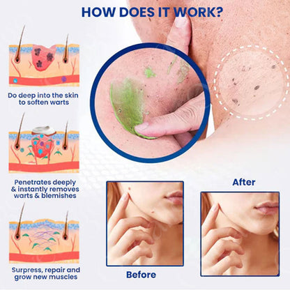 ✅ Official Store:  Ultra LOVILDS™ Instant Mole & Spot Removal Gel