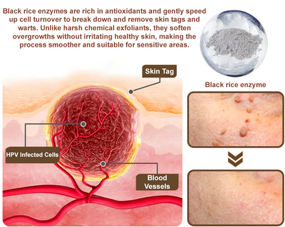ZvoRia™ Black Rice Skin Repair Essence Cream ⚕️ FDA Certified (Eliminates warts and skin tags, relieves psoriasis, improves keratin build-up and follicular keratinization, fades pigmentation, sun spots & age spots)