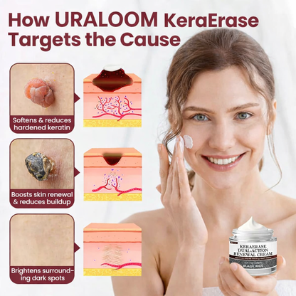 ✅Flash Sale - URALOOM®KeraErase Dual-Action Renewal Cream