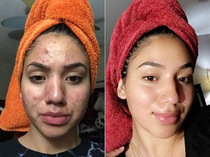 LOVILDS Authoritative Certification! Peel Shot Glow Rice Ampoule Duo - Developed and backed by board-certified dermatologists
